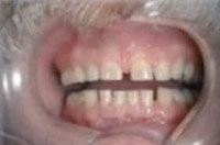 Sichtbare Zahnlücke