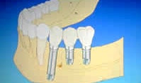 Implantatbrücke Schematischer Unterkiefer mit 3 Schraubimplantaten