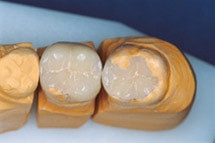 Inlays / Onlays aus Keramik oder Gold Inlays / Onlays aus Keramik oder Gold