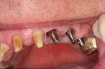 Implantatgetragener Zahnersatz Implantatgetragener Zahnersatz