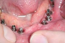 Zahnersatz bei komplexer Restauration Zahnersatz bei komplexer Restauration