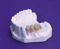 Keramikbrücke - Zahnarztpraxis Braunschweig Keramikbrücke in Unterkiefer-Modell